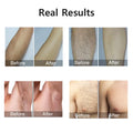 laser hair removal ipl