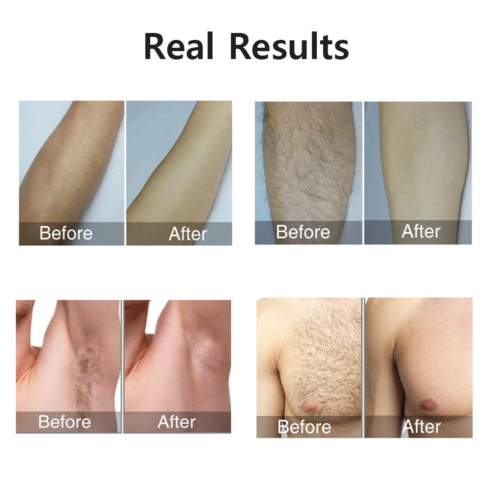 laser hair removal ipl